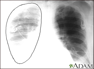 collapsed lung x ray