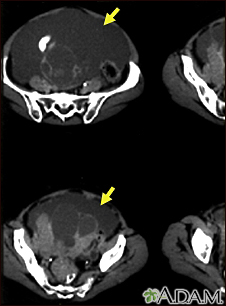 Ascites with ovarian cancer - CT scan - Illustration Thumbnail
                      