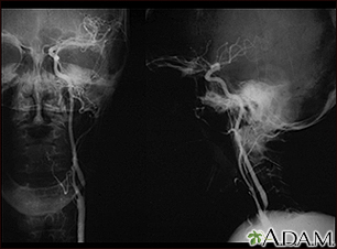 Carotid stenosis - X-ray of the left artery - Illustration Thumbnail
              