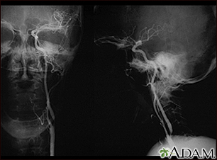 Carotid stenosis - X-ray of the left artery - Illustration Thumbnail              