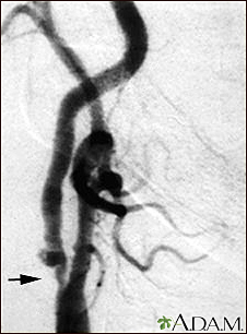 Carotid stenosis - X-ray of the right artery - Illustration Thumbnail              