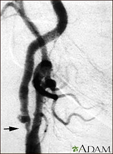 Carotid stenosis - X-ray of the right artery - Illustration Thumbnail							