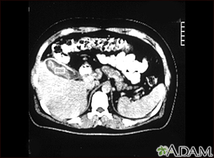 Cholecystitis, CT scan - Illustration Thumbnail              