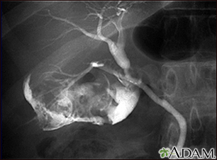 Cholecystitis - cholangiogram - Illustration Thumbnail
              