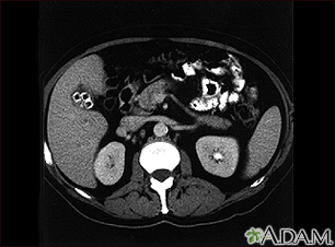 Cholecystolithiasis - Illustration Thumbnail
                      