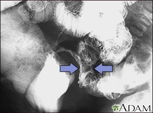 Crohn disease - X-ray - Illustration Thumbnail              