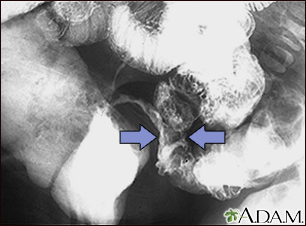 Crohn disease - X-ray - Illustration Thumbnail
                      