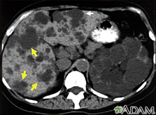 Kidney and liver cysts - CT scan - Illustration Thumbnail
              