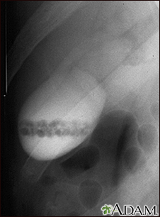 cholecystitis x ray