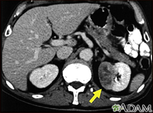 Kidney tumor - CT scan - Illustration Thumbnail              