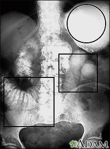 Ileus - X-ray of distended bowel and stomach - Illustration Thumbnail              