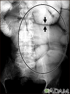 Ileus - X-ray of bowel distension - Illustration Thumbnail
                      