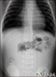 Intussusception - X-ray - Illustration Thumbnail
              