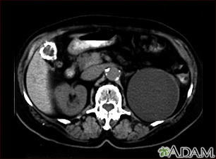 Kidney cyst with gallstones - CT scan