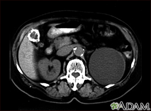 Kidney cyst with gallstones - CT scan - Illustration Thumbnail
              