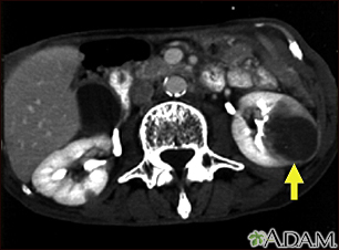 Kidney metastases - CT scan - Illustration Thumbnail
                      