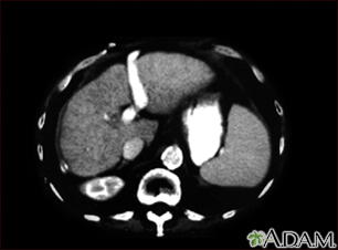 Liver cirrhosis - CT scan - Illustration Thumbnail