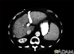 Liver cirrhosis - CT scan - Illustration Thumbnail
              