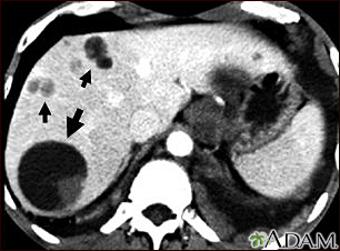 Liver echinococcus - CT scan - Illustration Thumbnail
              