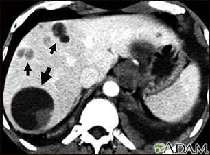 Liver echinococcus - CT scan - Illustration Thumbnail
                      