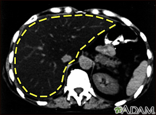 Fatty liver - CT scan - Illustration Thumbnail              