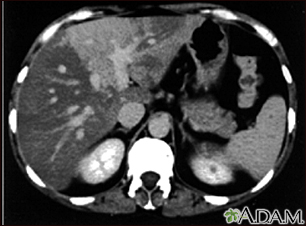 Liver with disproportional fattening - CT scan - Illustration Thumbnail
                      