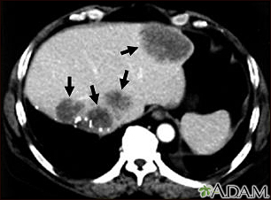 Liver metastases, CT scan - Illustration Thumbnail
              