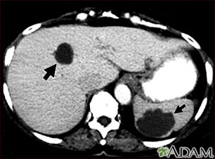 Liver and spleen cysts - CT scan - Illustration Thumbnail
              