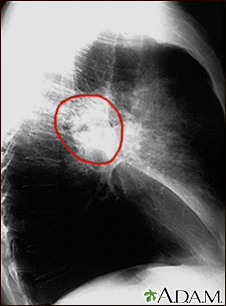 Lung cancer - lateral chest x-ray - Illustration Thumbnail
              