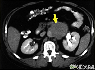 Lymph node metastases, CT scan - Illustration Thumbnail
              