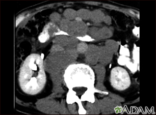 Lymphoma, malignant - CT scan - Illustration Thumbnail              