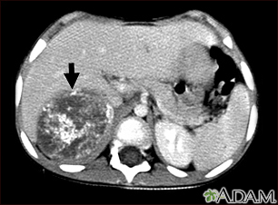 Neuroblastoma in the liver - CT scan - Illustration Thumbnail
                      