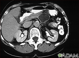 Pancreatic, cystic adenoma - CT scan