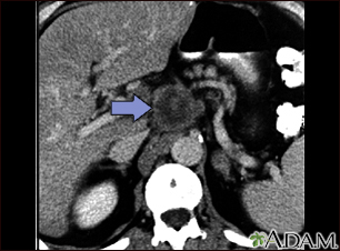 Pancreatic cancer, CT scan - Illustration Thumbnail
                      