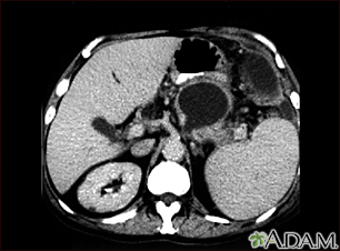 Which Cancers Can a Pelvic CT Scan Detect?