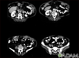 Peritoneal and ovarian cancer, CT scan - Illustration Thumbnail
              