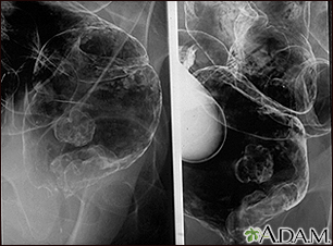 Rectal cancer - X-ray - Illustration Thumbnail
                      