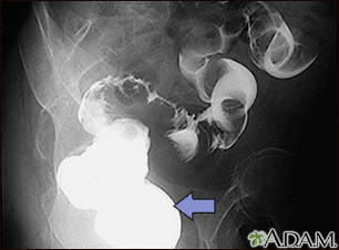 Sigmoid colon cancer - X-ray - Illustration Thumbnail              