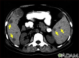 why ct scan abdomen pelvis