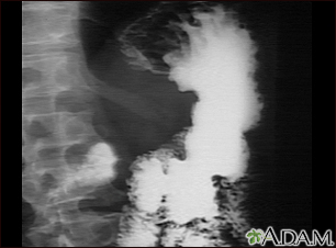 Stomach cancer, X-ray - Illustration Thumbnail
              