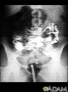 Volvulus - X-ray