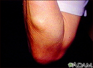 skin cyst on leg