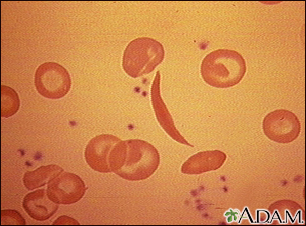 Red blood cells, sickle cell - Illustration Thumbnail
                      