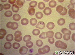Malaria - microscopic view of cellular parasites