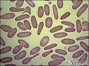 Red blood cells - elliptocytosis - Illustration Thumbnail
              
