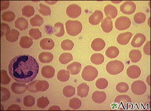 Red blood cells - spherocytosis