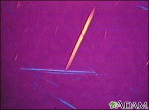 sodium urate in urine