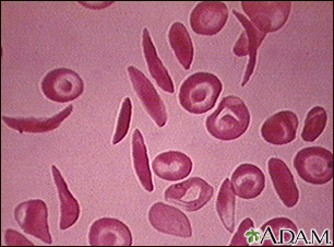 Red blood cells - multiple sickle cells - Illustration Thumbnail
              