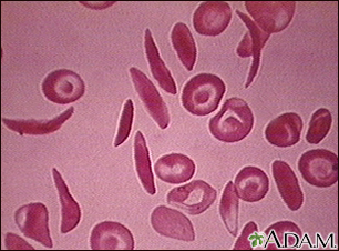 Red blood cells - multiple sickle cells - Illustration Thumbnail
                      