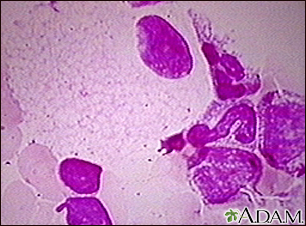 Niemann-Pick foamy cells - Illustration Thumbnail
                      